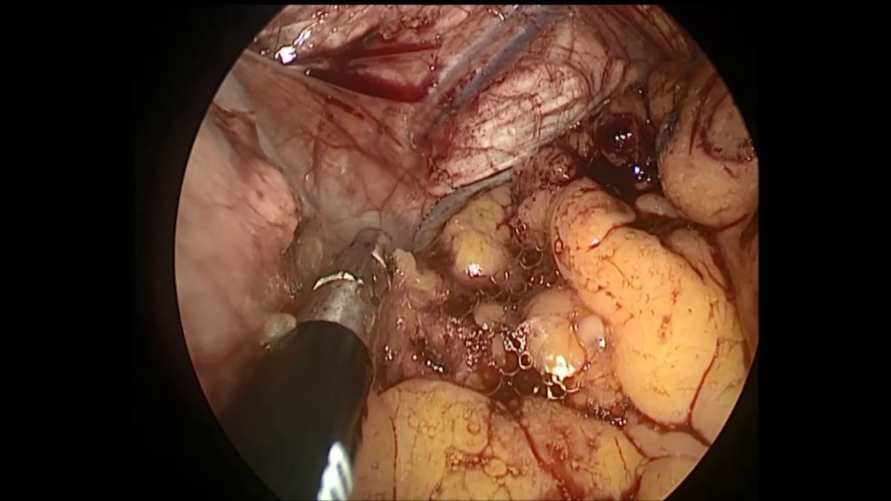 GIST Gastrointestinal stromal tumors HPB & GI Surgery