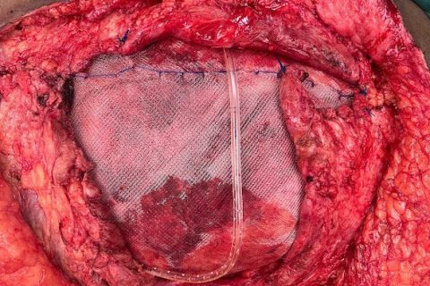 complex hernia repair