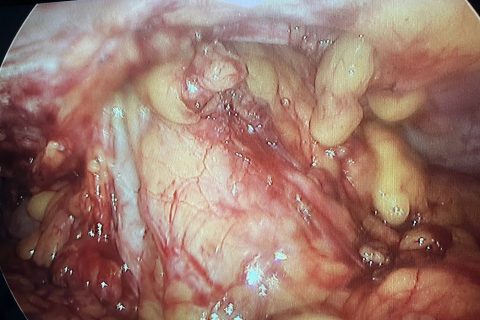 diaphragmatic hernia