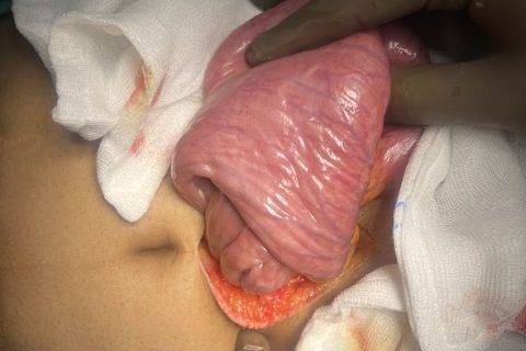 dudeno jejunal intussuception