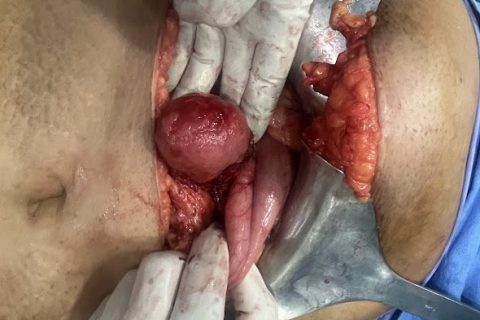 duodenal GIST