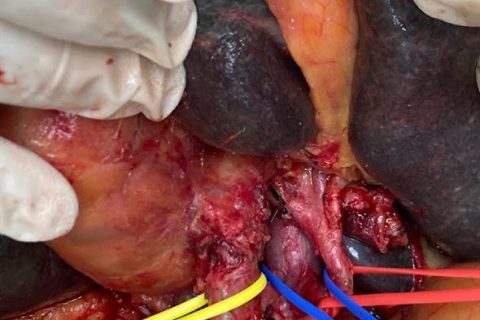 gall bladder cancer 1