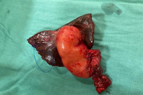 gall bladder cancer