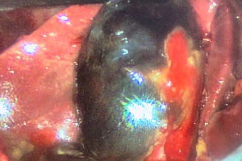 gangrenous cholecystitis