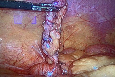 laparoscopic appendicectomy