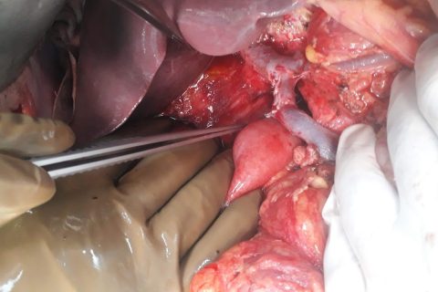 portal vein reconstruction after whipple