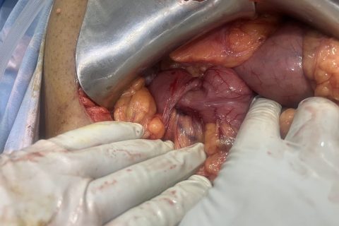 pyrolo duonenal intussception