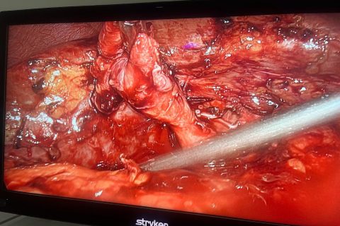stump cholecystectomy 1