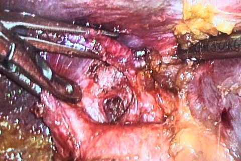 stump cholecystectomy