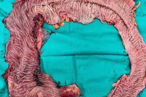 total colectomy